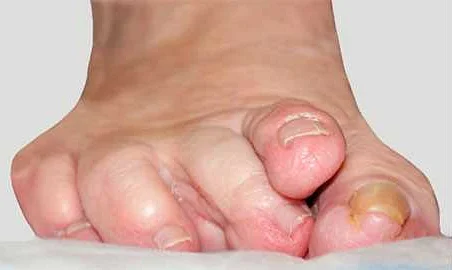 Болезненность и ограничения при деформации пальцев ног