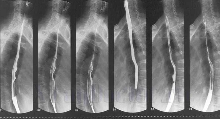 Особенности рентгена пищевода и желудка