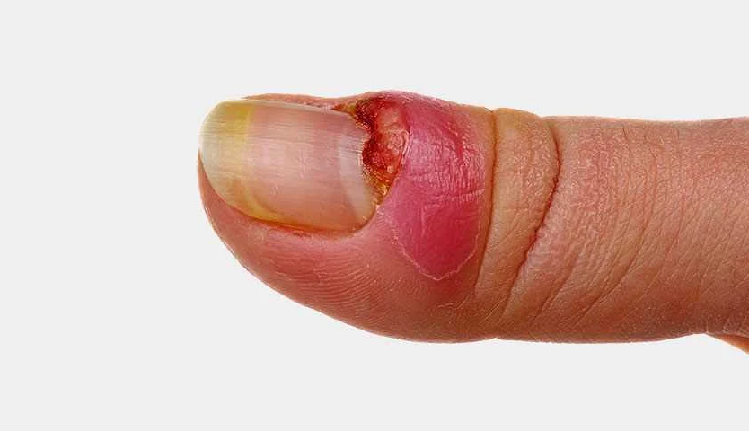 Как предотвратить гниение пальца