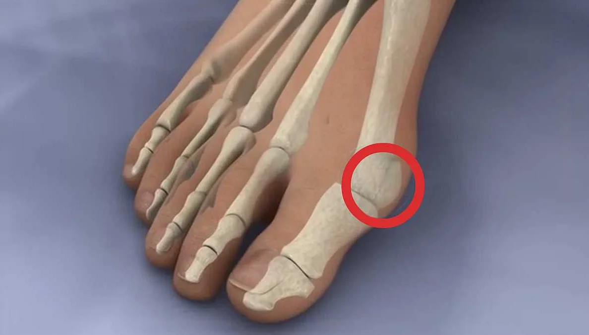 Профилактика возникновения косточки на большом пальце ноги