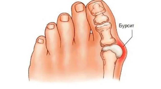 Причины возникновения косточки на большом пальце ноги