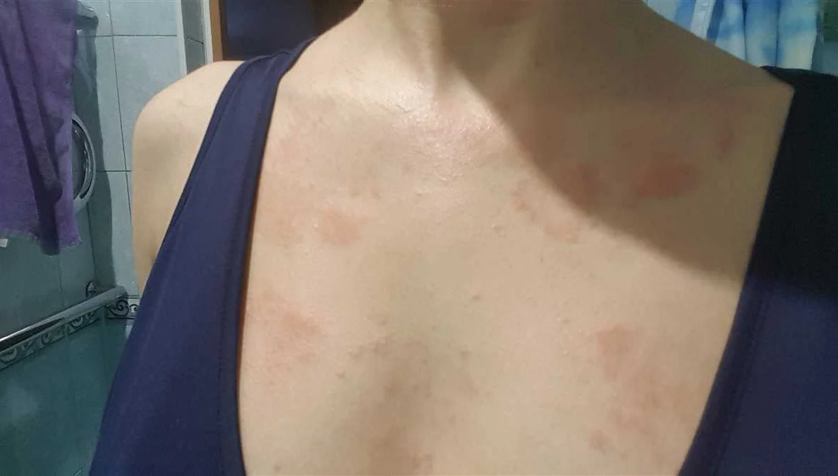 Аллергические реакции на коже