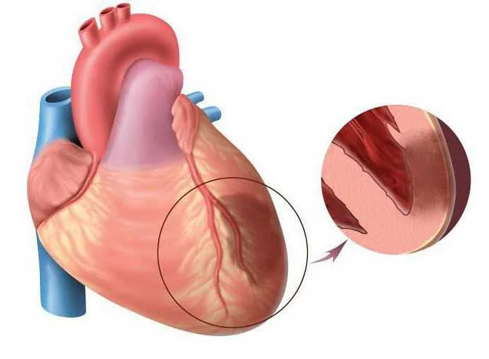 Причины возникновения острого инфаркта миокарда