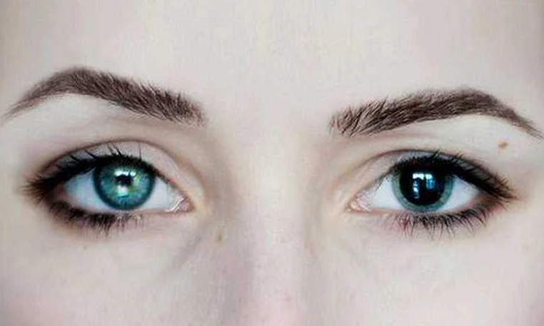Возможные причины увеличения зрачка одного глаза