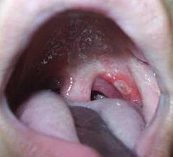 Сифилис губ: фото, симптомы и лечение