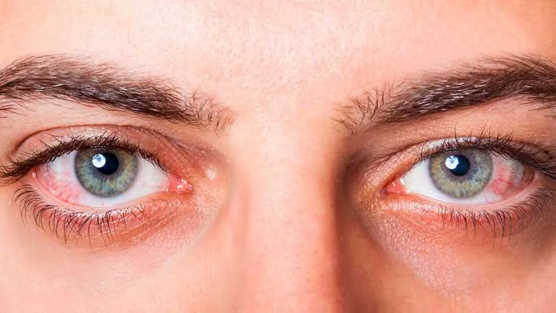 Заболевания, вызывающие отек глаза: какие проблемы могут стоять за этим симптомом?