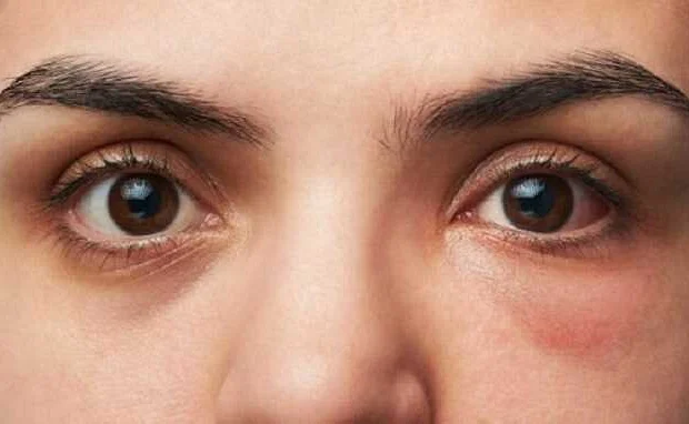 Лечение отека глаз: какие методы помогут справиться с этой проблемой?