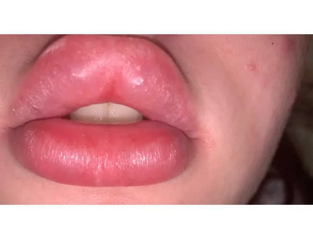 Причины появления синих губ у пожилых