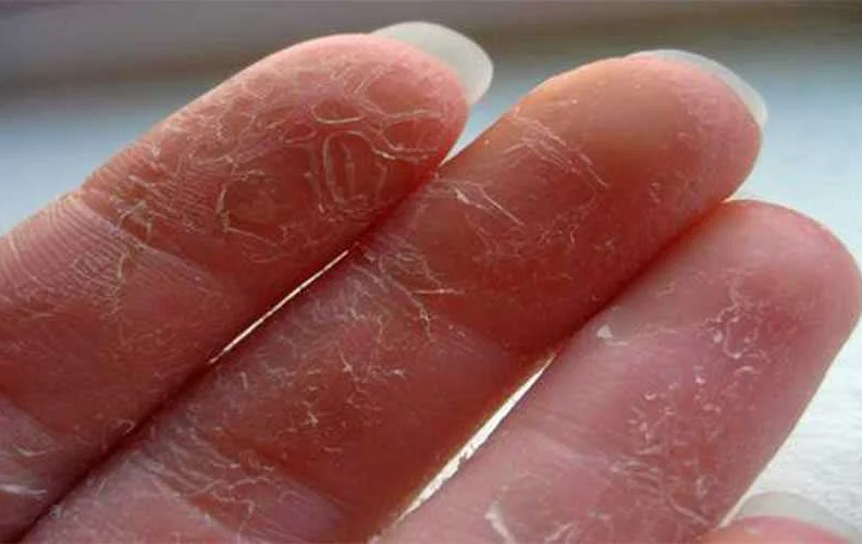 Почему у ребенка слазит кожа с пальцев: причины и способы решения проблемы