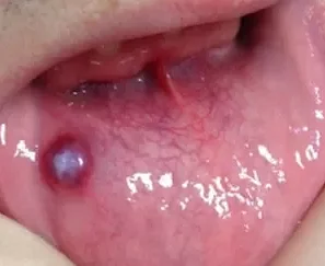 Какие последствия могут быть при неправильном лечении прозрачного пузыря во рту