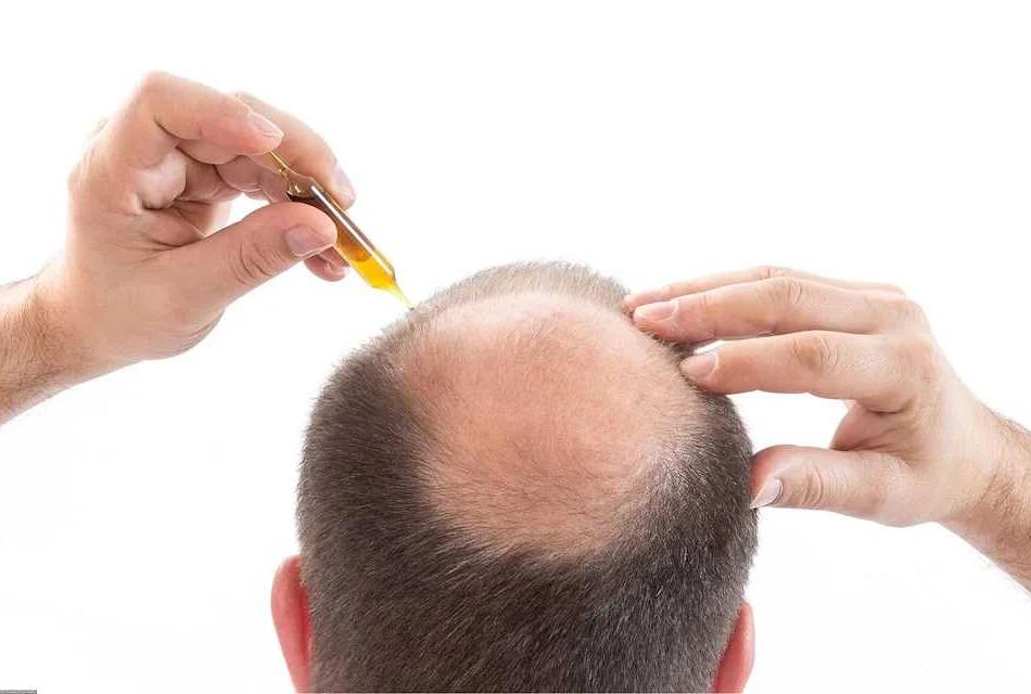 Нарушение цикла роста волос в связи с приемом препаратов