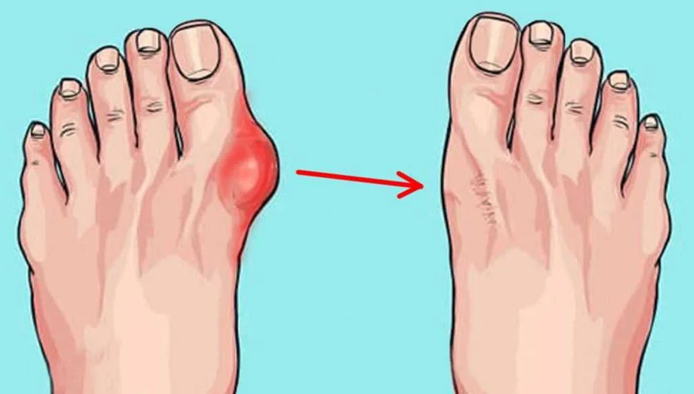 Основные симптомы шишки на ноге