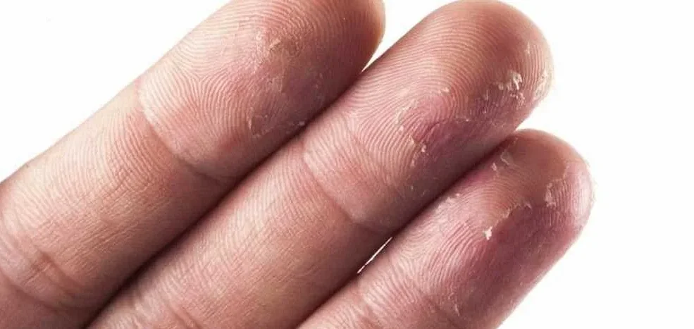 Что такое высыпание на пальцах?