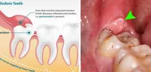 Симптомы и причины сильной боли после удаления зуба