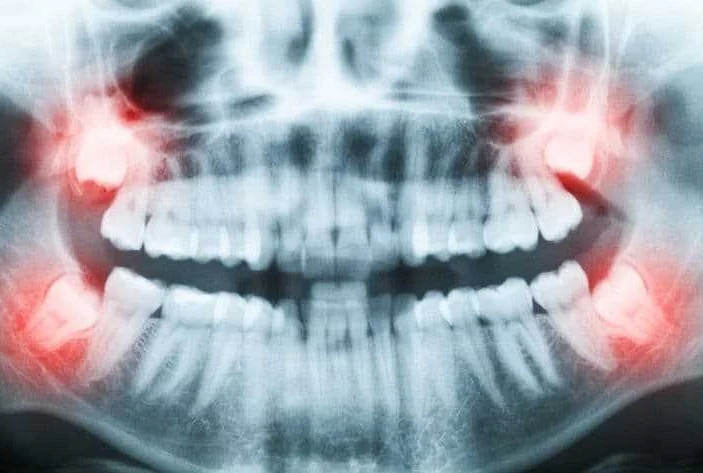 Когда нужно обратиться к стоматологу после удаления зуба