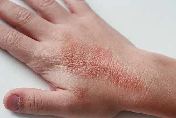 Как правильно ухаживать за кожей рук, чтобы избежать жжения