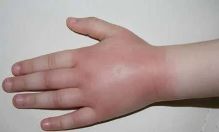 Питание и диета при жжении кожи рук