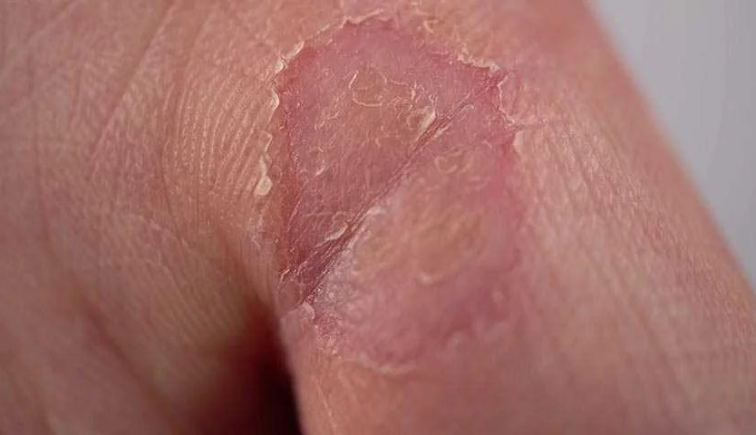 Причины и факторы, вызывающие жжение кожи рук